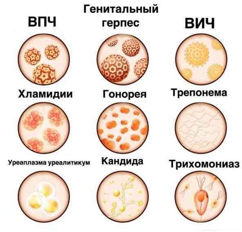 ВПЧ - венерическое заболевание, передающееся половым путем