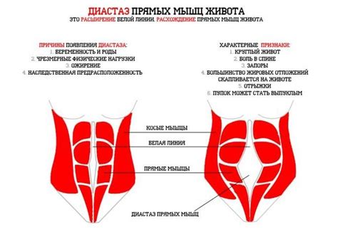 Виды диастаза живота и признаки