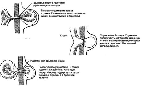 Влияние аномалий пупочного кольца