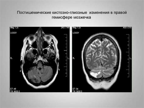 Влияние глиоза на прогноз выживаемости при опухолях головного мозга