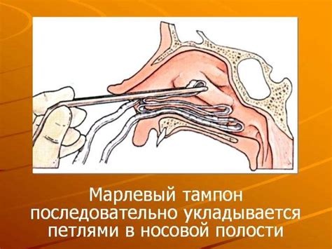 Влияние позы на носовое кровотечение