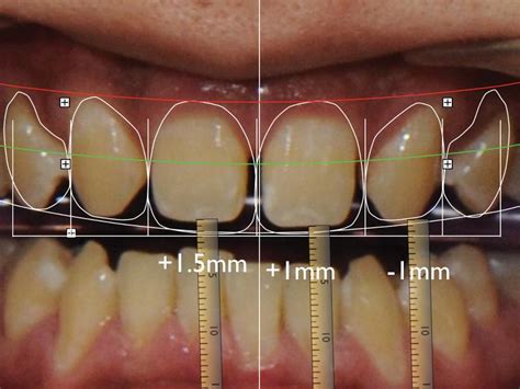 Влияние формы и размера зубов на эстетику улыбки