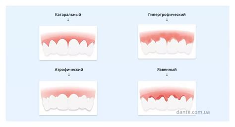 Влияние хлорофиллипта на воспаление десен