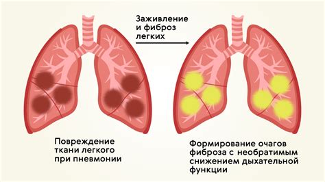 Воздействие ароматерапии при процедурах ухода после воспаления легких