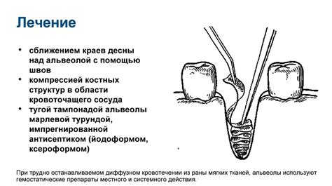 Возможные осложнения после удаления миндалины