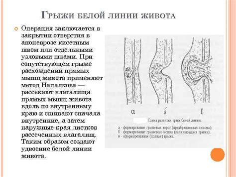 Возможные осложнения пупочной грыжи у ребенка