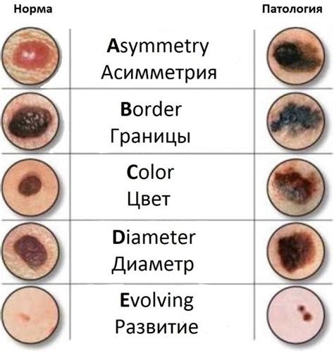 Возникают ли родинки с возрастом?