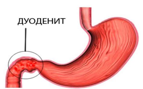 Воспаление желудочно-кишечного тракта и его проявления