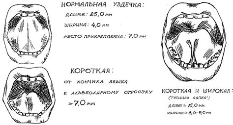 Второй метод определения длины уздечки языка