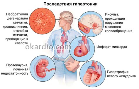 Гипертония: причины и симптомы