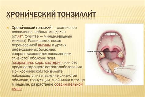 Главные причины возникновения тонзиллита