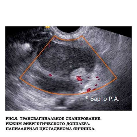 Диагностика кисты яичника