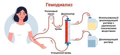 Диализ как метод лечения