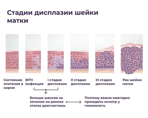 Дисплазия шейки матки