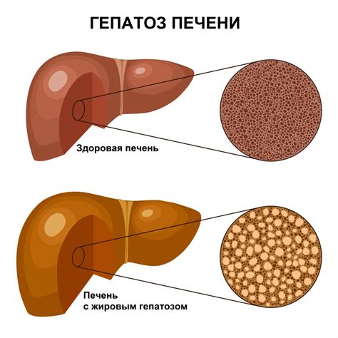 Жировый гепатоз: особенности заболевания