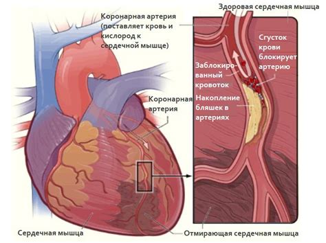 Загрязнение окружающей среды и ишемическая болезнь сердца