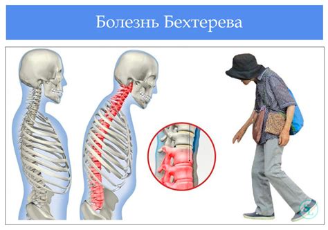 Заниматься бегом при болезни Бехтерева: полезно или опасно?