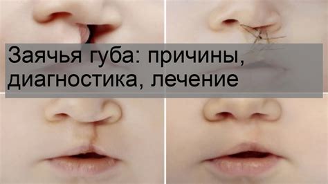 Заячья губа: медицинские аспекты