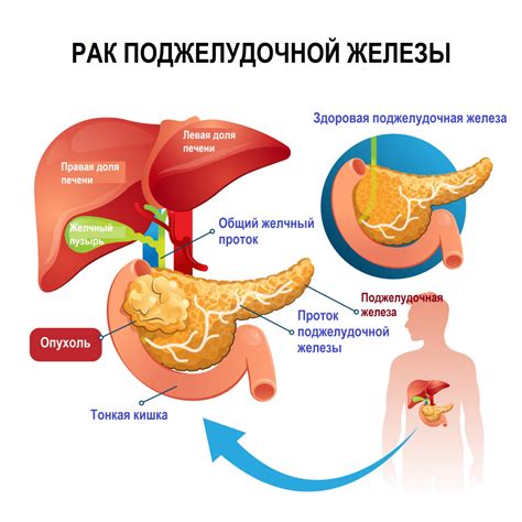 Злокачественная опухоль поджелудочной железы: причины, типы и симптомы