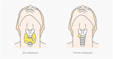 Исчезновение и снижение узлов в щитовидной железе