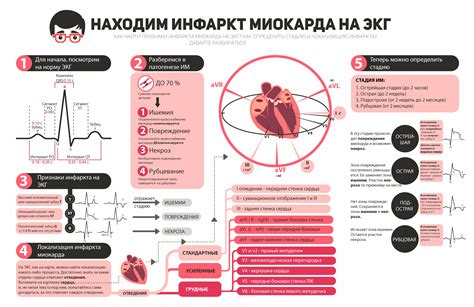 Какие изменения отражаются на ЭКГ