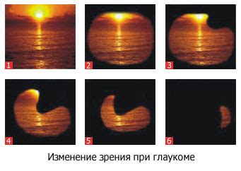 Как избежать факторов риска для сохранения зрения при глаукоме?