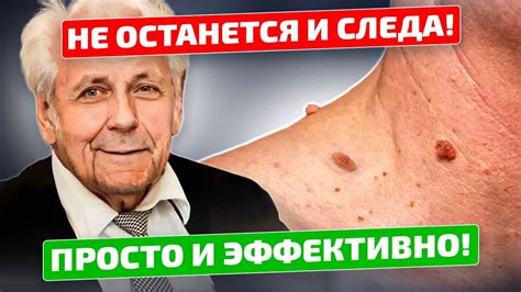 Как использовать перекись водорода для лечения папиллом?