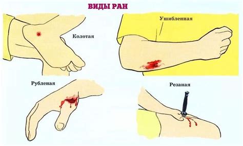 Как предотвратить появление ран и повреждений