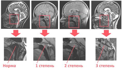 Как проводится рентген аденоидов?