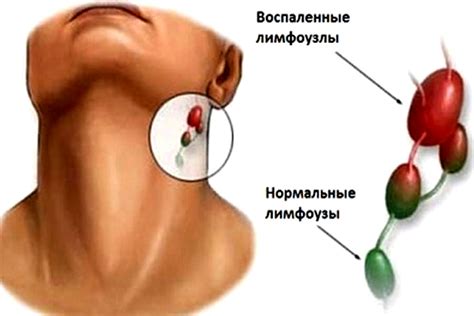 Как происходит воспаление лимфоузла от продуло?