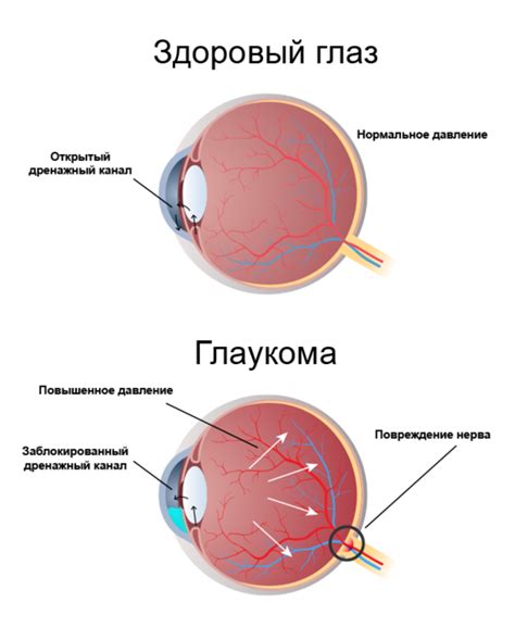 Как проявляется глаукома?