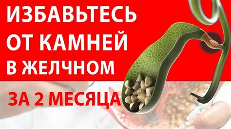 Как удалить камни из желчного пузыря самостоятельно?