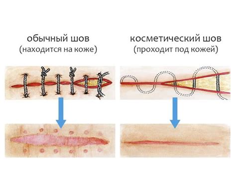 Когда необходимо снимать швы после разрывов