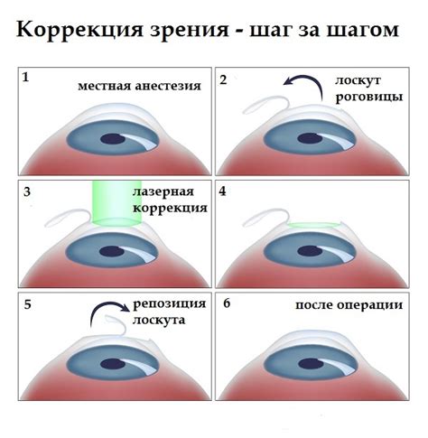 Лазерная коррекция близорукости