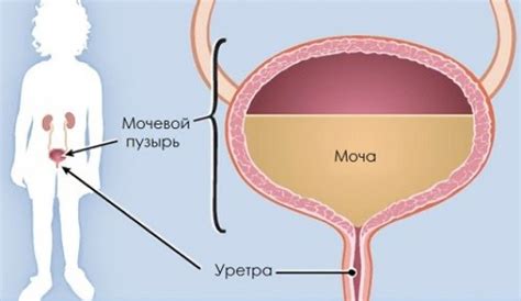 Лечение лейкоплакии мочевого пузыря: основные принципы