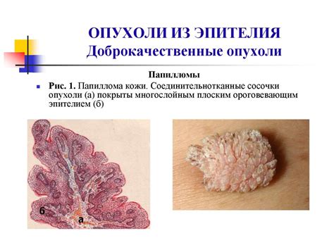 Методы профилактики и снижения риска развития опухоли из глиоза