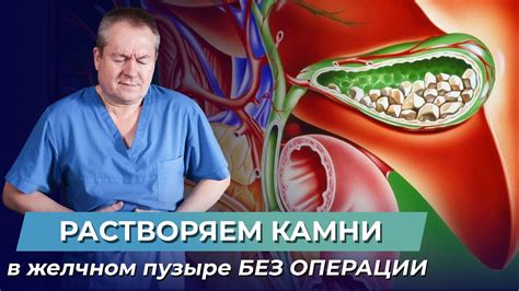 Методы удаления камней в желчном пузыре