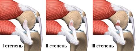 Механизм растяжения связок и возникающая боль