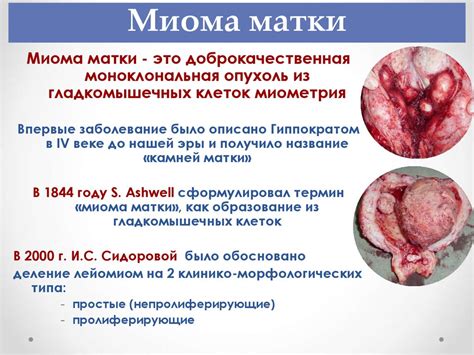 Миома и ее риски