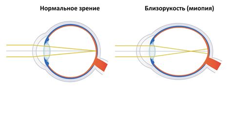 Миопия и долгосрочные последствия для доноров