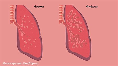 Мифы и правда о гигиефе после воспаления легких