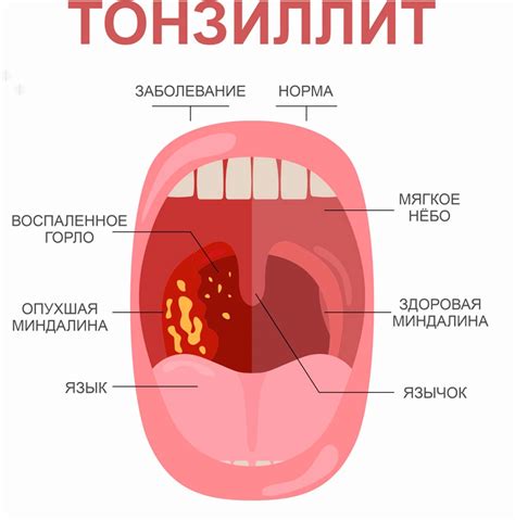 Можно ли оперативно удалять миндалины при тонзиллите?