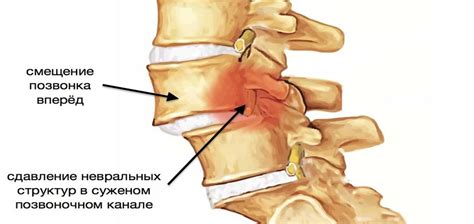 Нерациональная физическая нагрузка и смещение позвонков