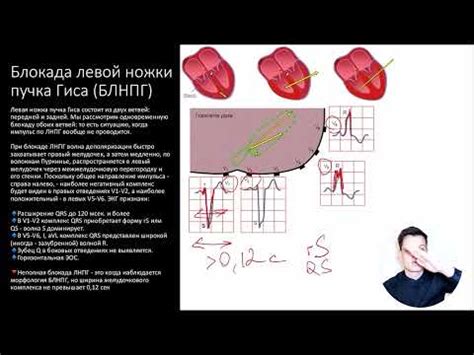 Общая информация о нарушении внутрижелудочковой проводимости