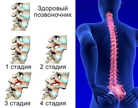 Ограничение общей подвижности при смещении позвонков