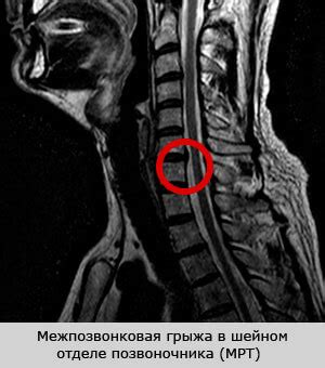 Операция при грыже позвоночника - риски и последствия