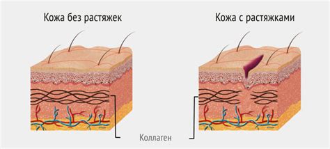 Основные методы лечения растяжек на груди после родов