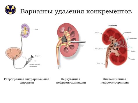 Основные причины выхода песка из почек