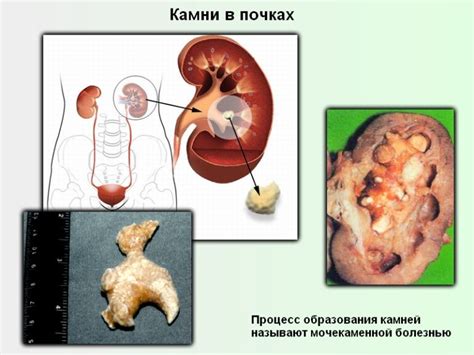 Основные симптомы поноса при камнях в почках