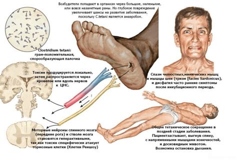 Основные симптомы столбняка